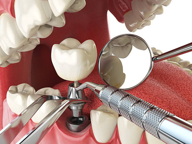 Best Emergency Dental Extractions in Toronto, OH