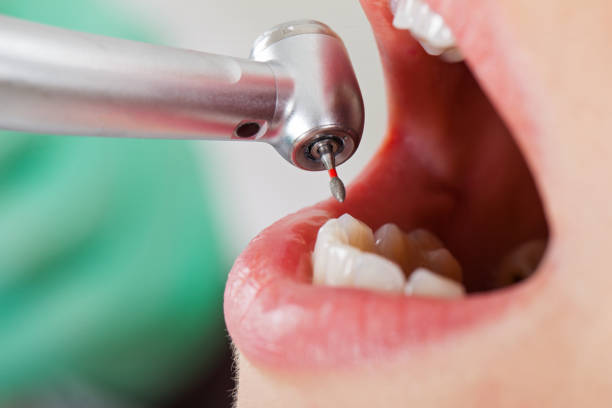 Best Emergency Dentist for Lost Fillings or Crowns in Toronto, OH